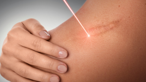 Ветеранам оплачуватимуть послуги з корекції рубців шкіри - деталі нового проєкту